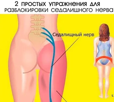 Синдром грушевидной мышцы: симптомы, лечение в Херсоне | Neuro.ks.ua.