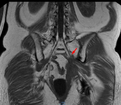 Защемление седалищного нерва (Ишиалгия) - Vertebra