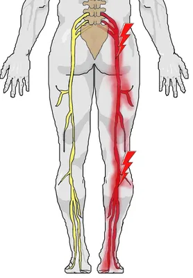 Симптомы и причины ишиаса.