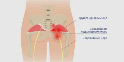 Синдром грушевидной мышцы. . Статьи