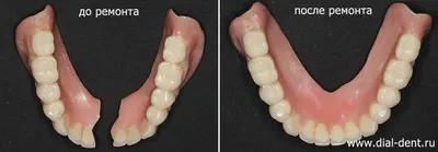 Ремонт съемного зубного протеза за 2 рабочих дня