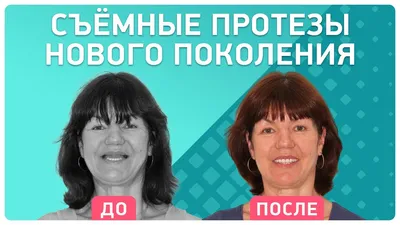 Минусы съемного протезирования и его плюсы | Крона Дент стоматология СПБ |  Дзен