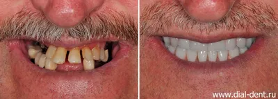 Съемные зубные протезы фото до и после