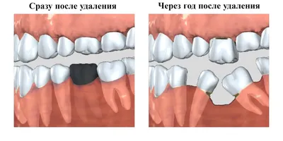 Съемные зубные протезы в Хабаровске: цены, виды и отзывы в EsteticaDent.ru