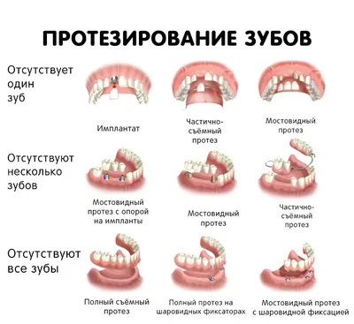 ЗУБНЫЕ ПРОТЕЗЫ. Статья о разных видах протезов зубов.