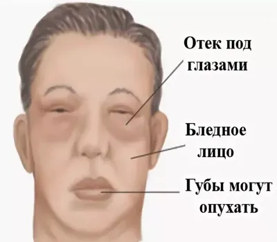 Отекают ноги? 🔍Самостоятельно разбираемся в причине отека ног и что с этим  делать. Часть вторая: 💓 сердечные, почечные и лекарственные. | Врач  Алексей Мареев | Дзен