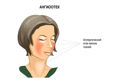 Болезни сердца - кожные симптомы и необходимая диагностика