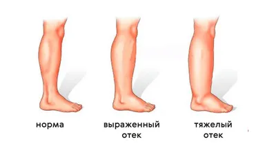 Как избавиться от отеков: советы косметолога и 5 лучших патчей | ELLE