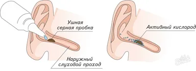 Как удалить серную пробку из уха в домашних условиях