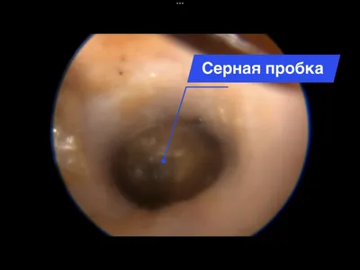 Удаление серной пробки Ставрополь | Клиника Эксперт