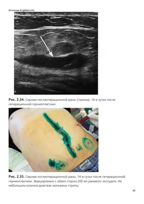 Серома после абдоминопластики. Как нам не допустить ее появления? | Евгений  Фролов | Дзен