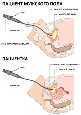 Цистоскопия | Ida-Tallinna Keskhaigla