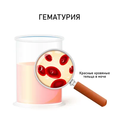 Гематурия (кровь в моче) у женщин и мужчин: причины, что означает, виды,  лечение