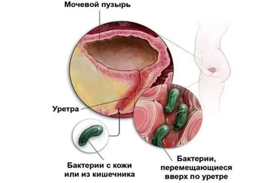 Сгустки крови в моче - симптом различных заболеваний у женщин и мужчин |  Университетская клиника