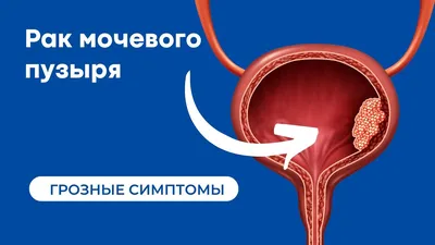 Почему появляется кровь в моче и что делать: диагностика и лечение в  АнапеПричины видимой и невидимой крови в моче, какие заболевания вызывают  гематурию. Расширенная диагностика в Анапе: цистоскопия, МРТ, КТ, анализы.