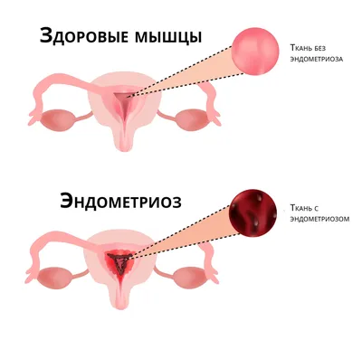 Сгустки крови при месячных похожие на печень и мясо