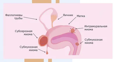 Сгустки при месячных фото