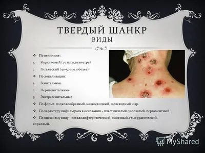 Сифилис — диагностика и лечение