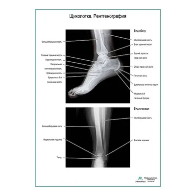 Щиколотка. Рентгенография плакат глянцевый А1+/А2+ › Купить оптом и в  розницу › Цена от завода