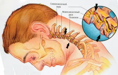 Шейный остеохондроз: симптомы и лечение | Клиника Temed