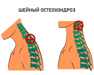 Остеохондроз шейного отдела: причины, симптомы, как избавиться, лечение