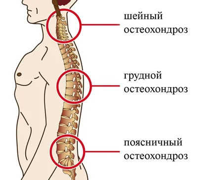 ВСД и остеохондроз. Симптомы вегетососудистой дистонии с шейным  остеохондрозом.