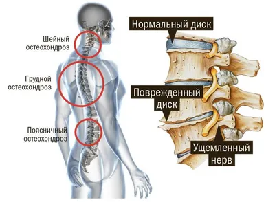 Можно ли полностью вылечить шейный остеохондроз, самомассаж в домашних  условиях - СНТА