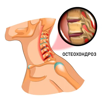 Шейный остеохондроз: симптомы проявления | МЦ AXON.