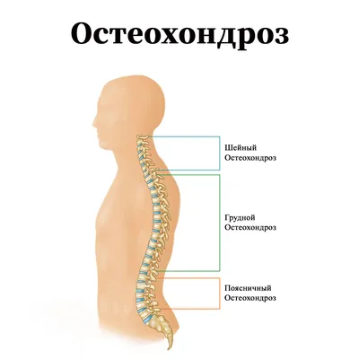 Остеохондроз. Лечение остеохондроза. Симптомы остеохондроза - Киев, Львов,  Ивано-Франковск