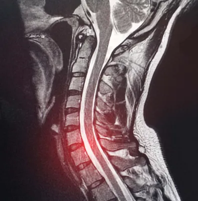 Остеохондроз лечение в клинике VERTEBRA | Киев