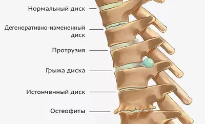 Шейный остеохондроз ✔️: симптомы, признаки и лечение остеохондроза шейного  отдела