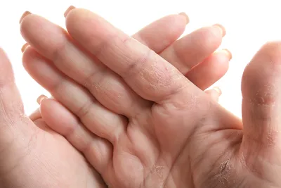 Почему трескается кожа на руках | блог Expert Clinics