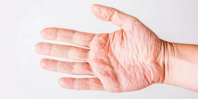 Почему шелушится кожа на руках: причины, лечение и профилактика