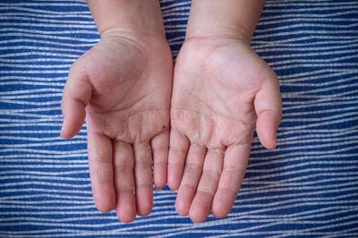 Кожа рук шелушится от болезни | Премиум Фото