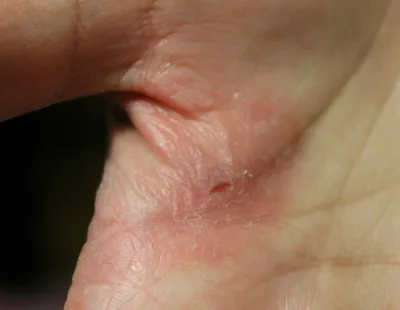 Почему трескается кожа на пальцах рук около ногтей?