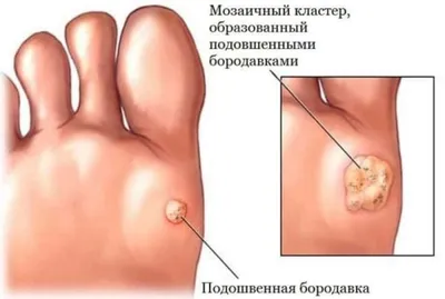 Что такое шипица и как ее лечить? | МЦ Лазерсвiт