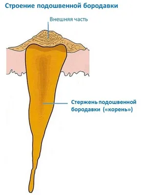 Подошвенная бородавка (шипица)‼️... - Victory podology | Facebook