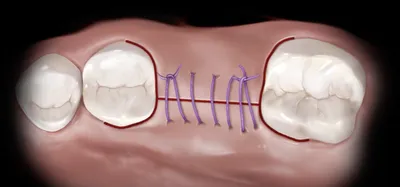 Свищ на десне: причины, как выявить и что делать? - DentBerg