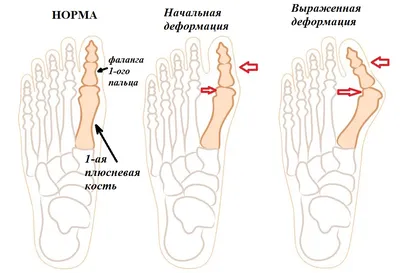 Почему появляется шишка на ноге: причины и способы лечения. Спорт-Экспресс