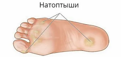 Экзостоз подногтевой - причины, симптомы, диагностика, лечение и  профилактика