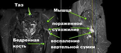 Правка Атланта Бишкек Кыргызстан - Вдовий горбик или локальная  липодистрофия. ⠀ Это холка, жировое отложение на шее в районе седьмого  позвонка. На начальной стадии он может быть не заметен, т.к. не приносит