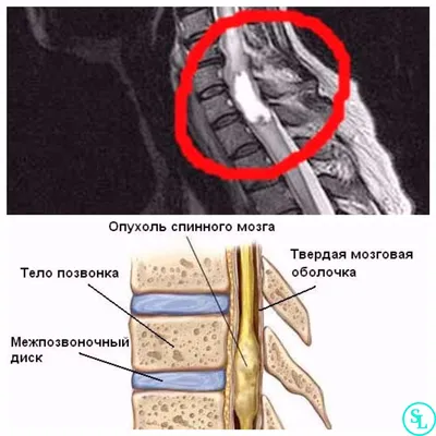 Шишка на шее, боли - Вопрос онкологу - 03 Онлайн