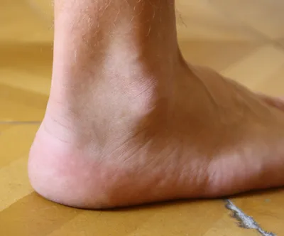 https://ortomed-clinic.ru/articles/hallux-valgus/shishka-na-vneshney-storone-stopy/