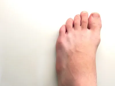 https://ortomed-clinic.ru/articles/hallux-valgus/shishka-na-vneshney-storone-stopy/