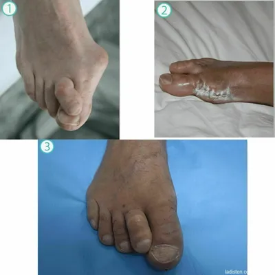 Hallux valgus — Википедия