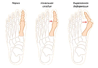 Воспалилась и болит косточка на ноге у большого пальца, что делать? |  медицинские товары и медтехника в магазине Ортосалон