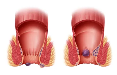 Внутренний геморрой: симптомы заболевания, признаки, стадии развития,  лечение