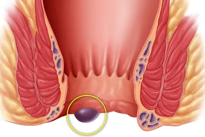 Геморроидальные узлы: симптомы, способы лечения геморроидальных шишек