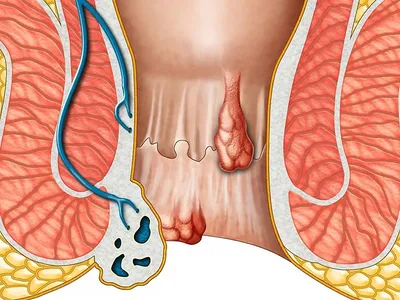 Геморрой - симптомы, лечение, причины и профилактика геморроя - Гармония