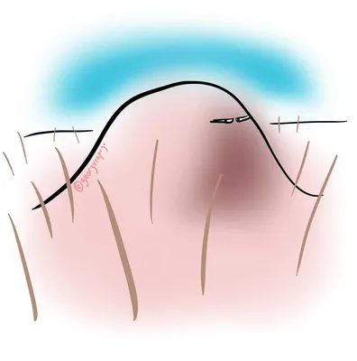 Как убрать уплотнения после уколов на ягодицах | Дом Исцеления | Дзен